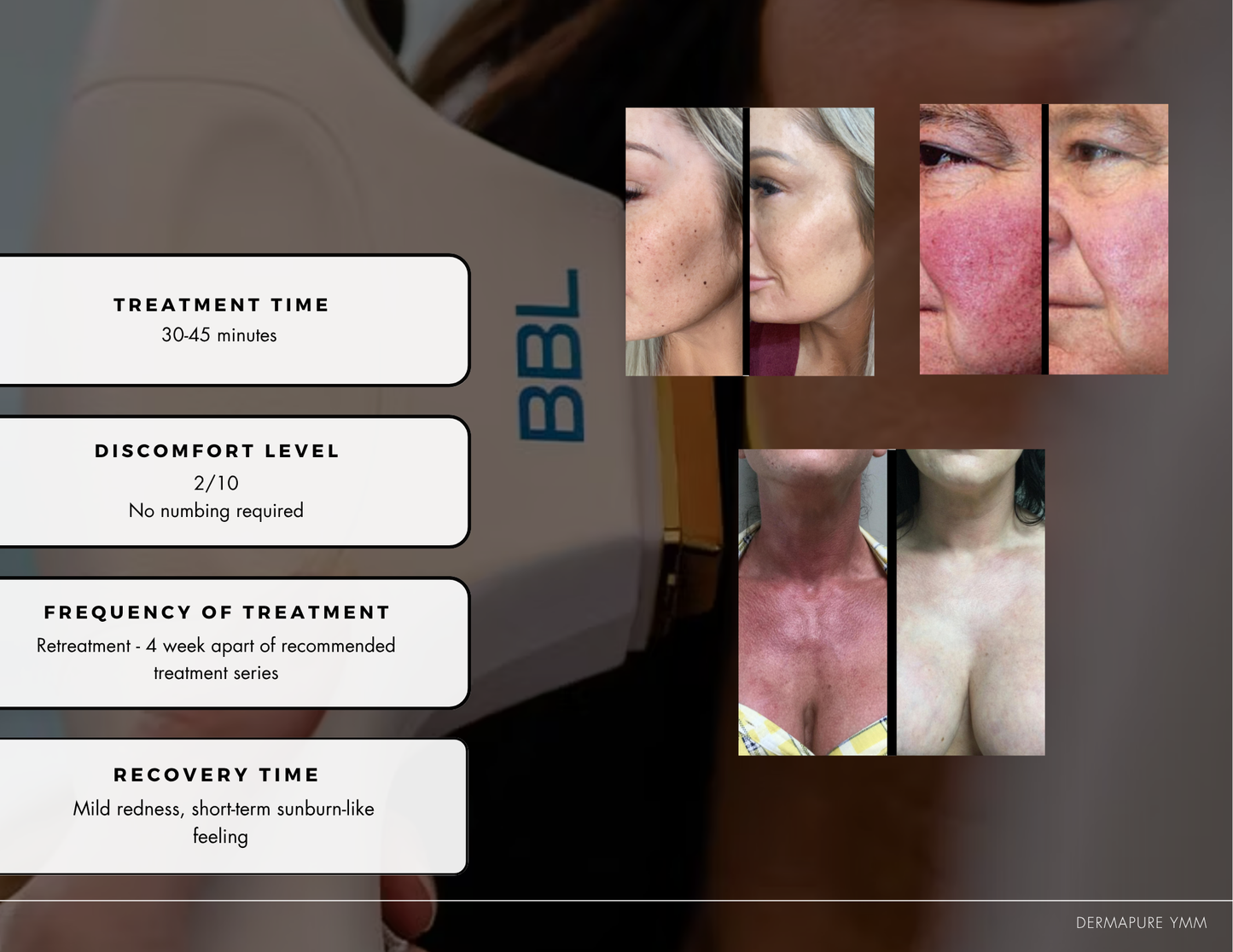 BBL (Broad Band Light)