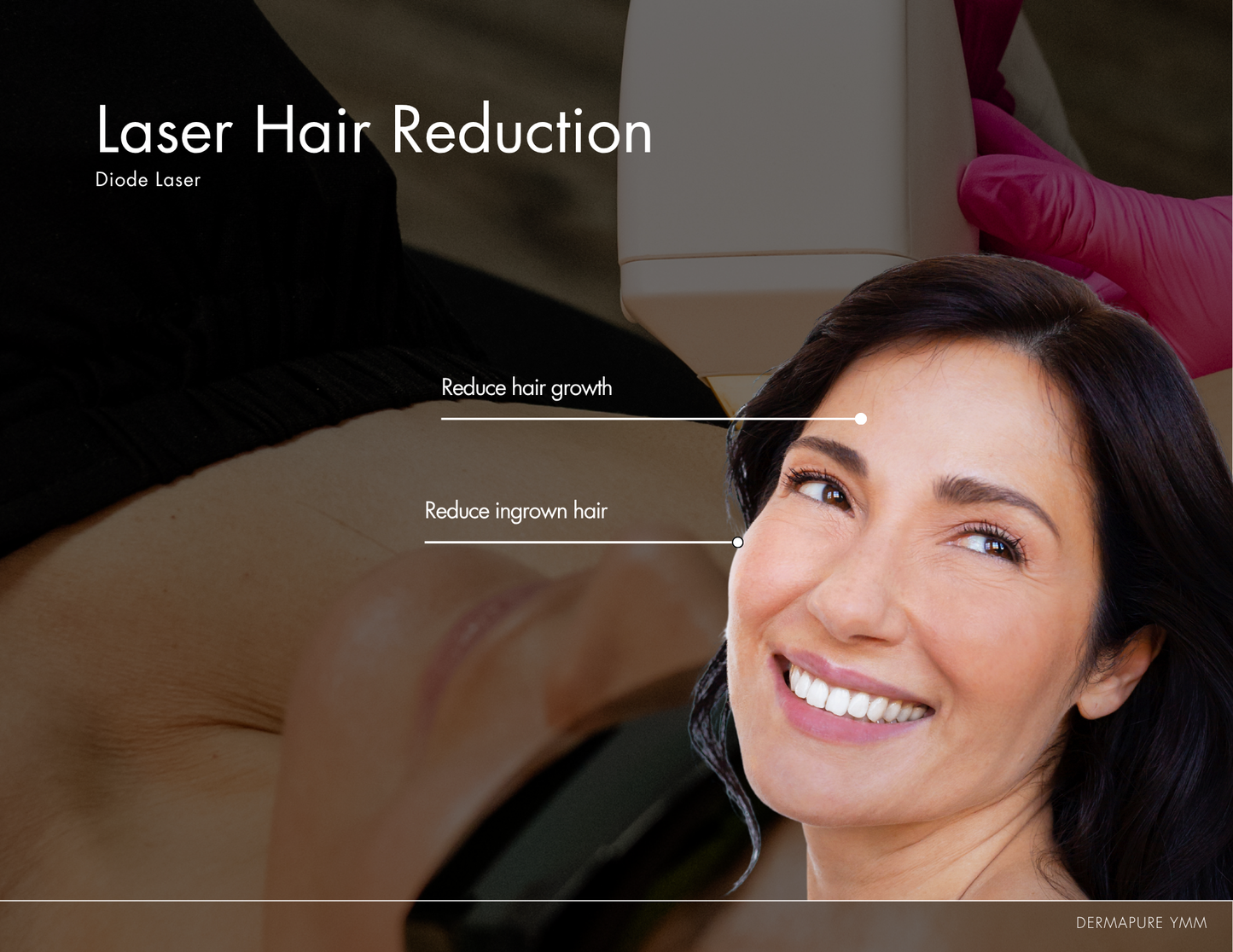 Laser Hair Removal
