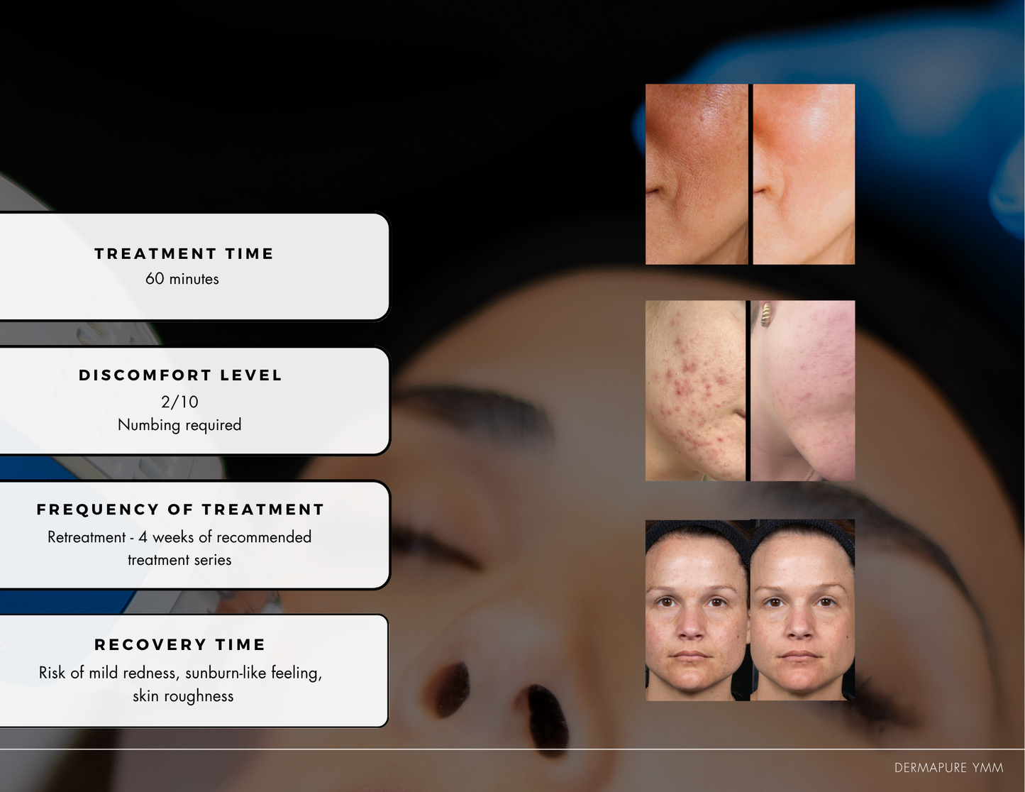 Clear & Brilliant Laser Treatment